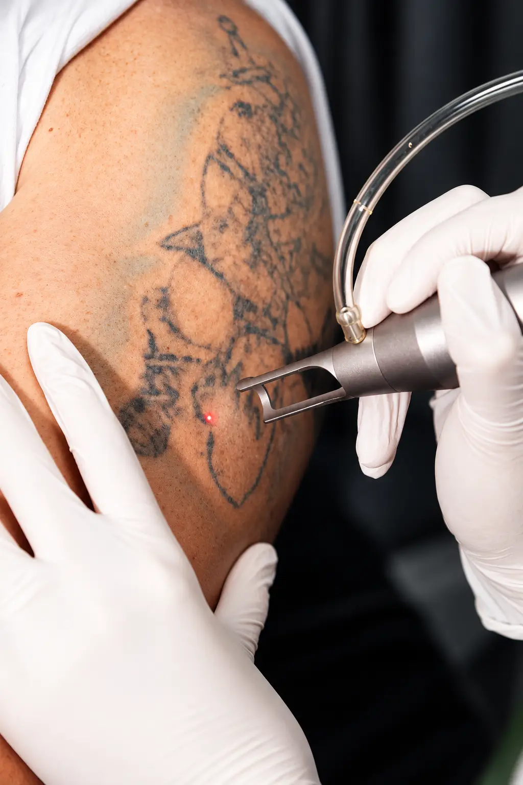 Prozess währen der Tattooentfernung in Arbon